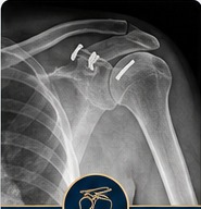 Post-operative shoulder rotator cuff repair X-ray