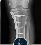 High tibial osteotomy post-operative X-ray