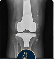 Post-operative knee replacement X-ray