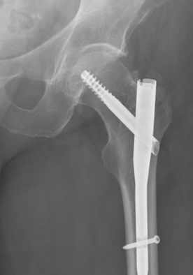 Fracture X-rays with plate fixation